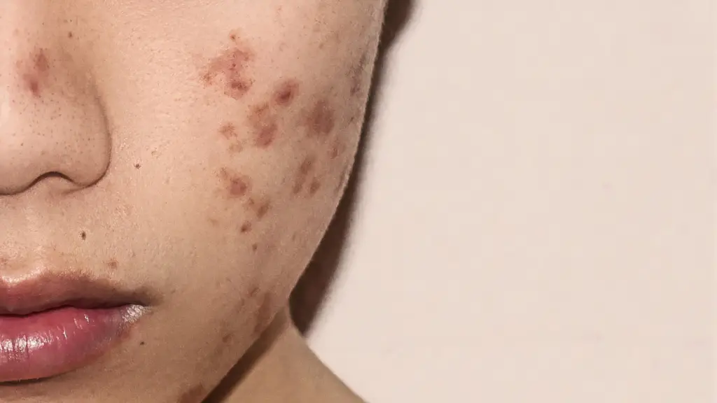 Acne in teenagers