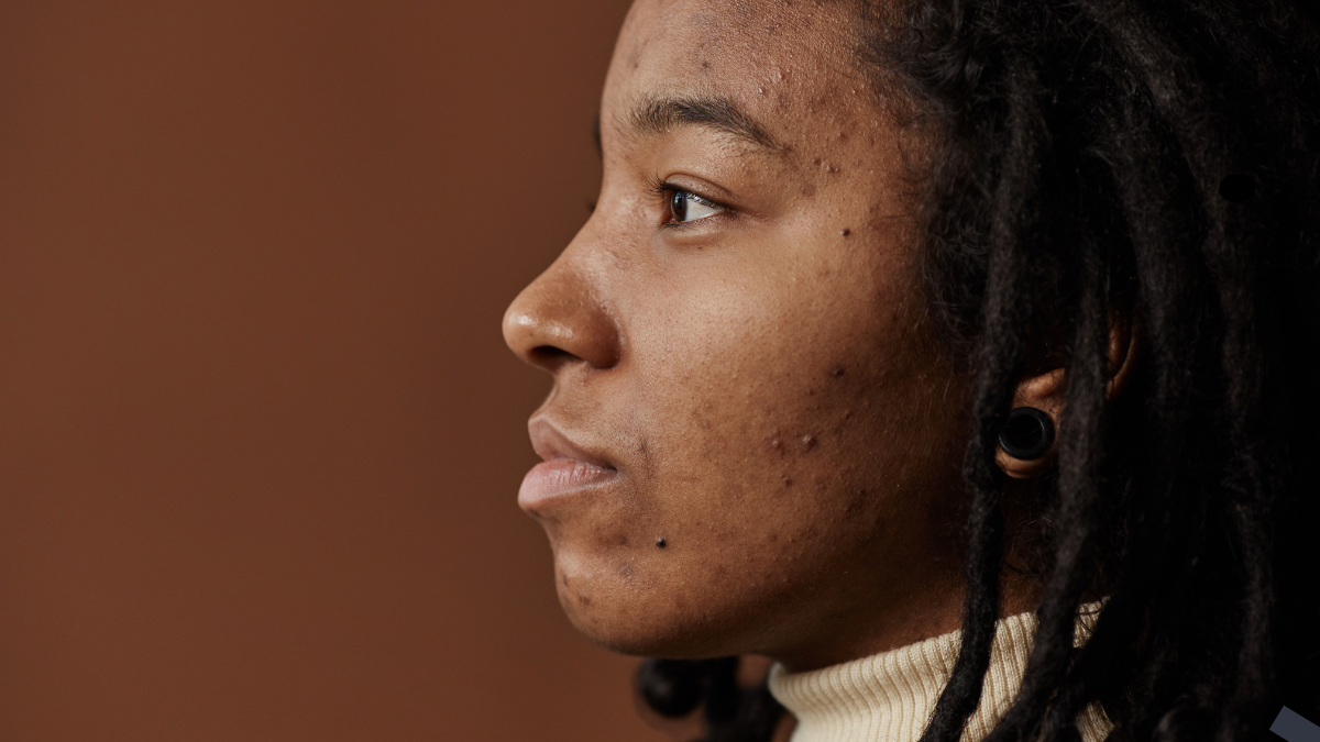 You are currently viewing Clear Skin Chronicles: Personal Journeys in Acne Treatment.